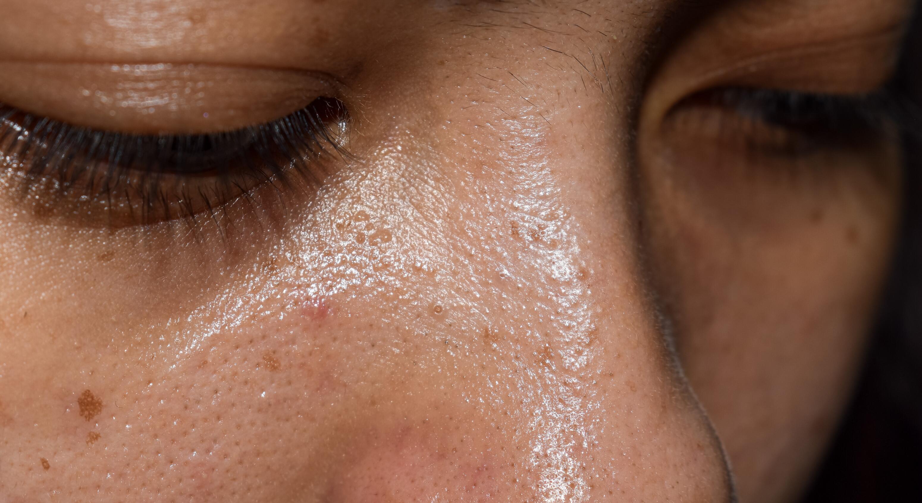 Retentionele acne met vette huid